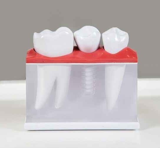 Dental Implants