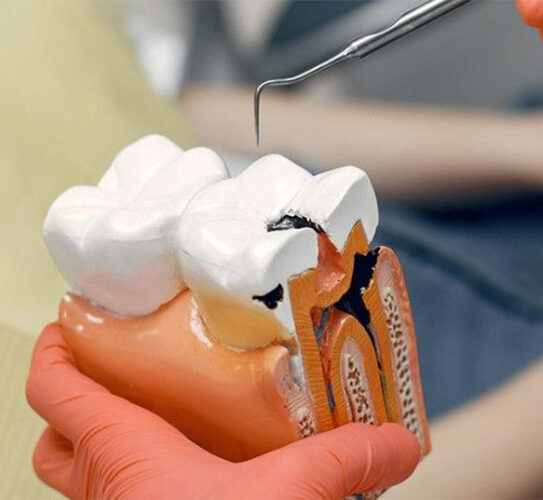 Root Canal Therapy