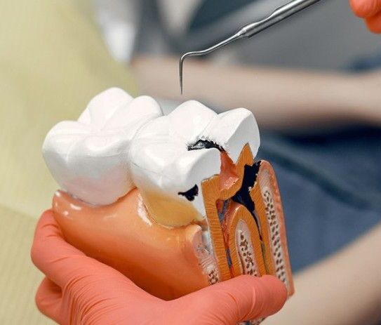 Root Canal Therapy