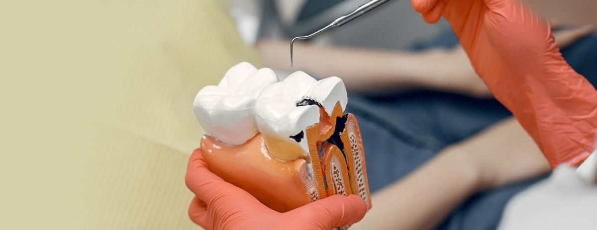 Root Canal Therapy